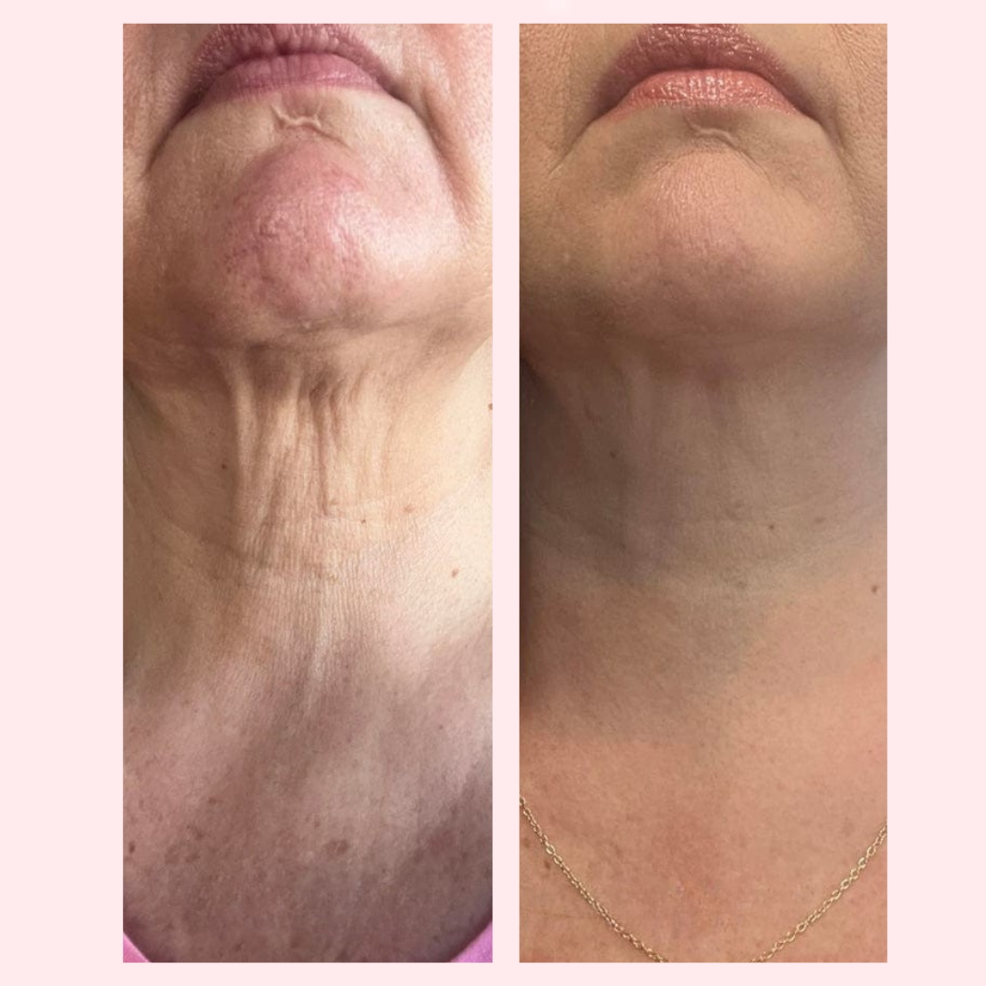 Decolleté Anti-Aging Serum - LiftLijn™ Peptiden