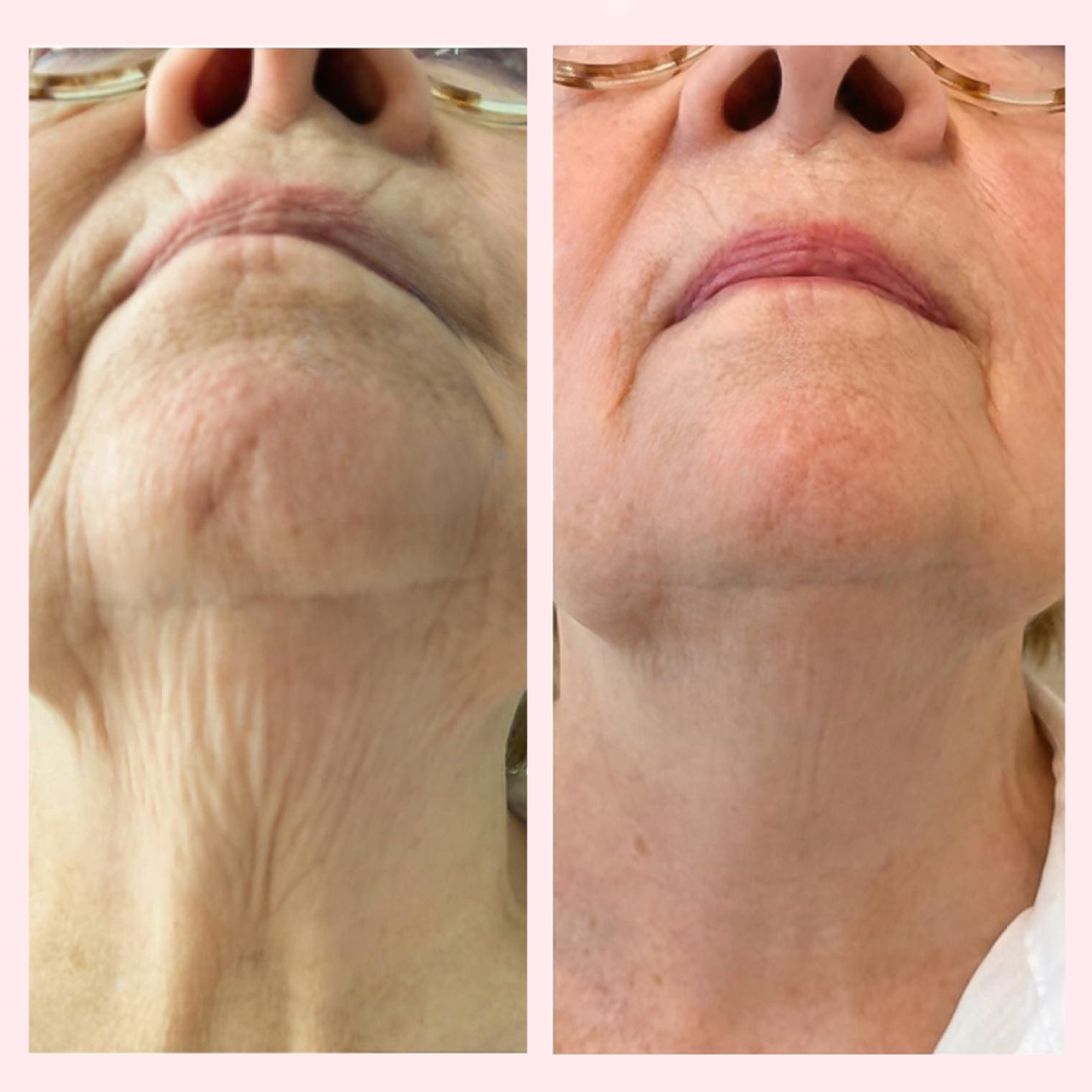 Decolleté Anti-Aging Serum - LiftLijn™ Peptiden