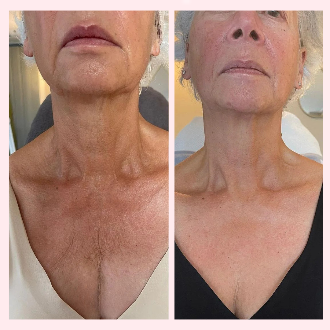Decolleté Anti-Aging Serum - LiftLijn™ Peptiden