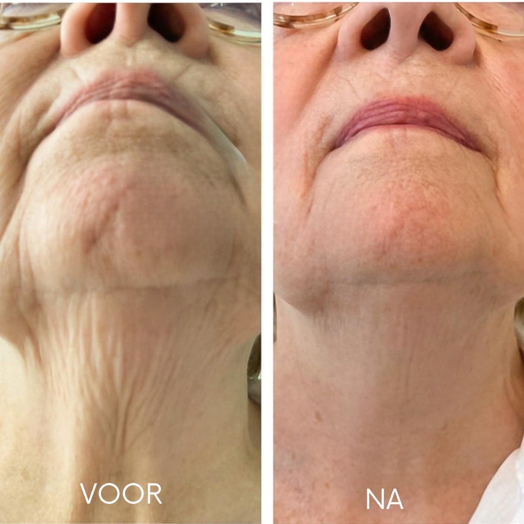 Before and after results of a decollete anti-aging serum, showing visible tightening and reduction of wrinkles.